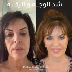 شد الوجه والرقبة في دبي Best Facelift Surgeon Dubai UAE 1