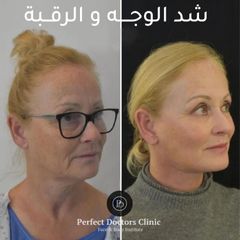 شد الوجه والرقبة في دبي Best Facelift Surgeon Dubai UAE 2
