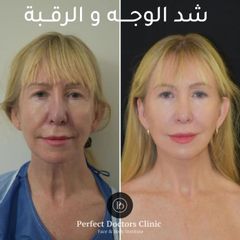 شد الوجه والرقبة في دبي Best Facelift Surgeon Dubai UAE 3