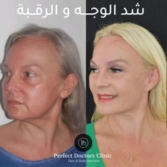 شد الوجه والرقبة في دبي Best Facelift Surgeon Dubai UAE 4