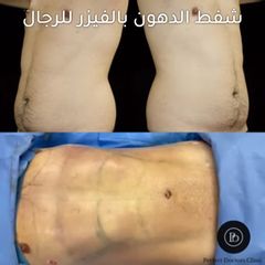 افضل جراح تجميل شفط دهون البطن بالفيزر للرجال ب دبي Best Male vaser liposuction surgeon dubai 1