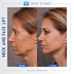 NECK AND FACE LIFT (4)