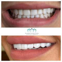 ابتسامة هوليود - المركز الأوروبي لطب الأسنان