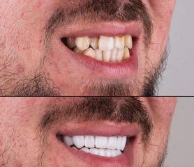 عملية تجميل الأسنان - دوراك الصحة