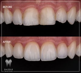 فينير الأسنان - مركز دازل لطب الأسنان