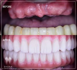 عملية زراعة الأسنان - مركز دازل لطب الأسنان