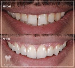 فينير الأسنان - مركز دازل لطب الأسنان