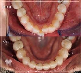 تقويم الأسنان - مركز دازل لطب الأسنان