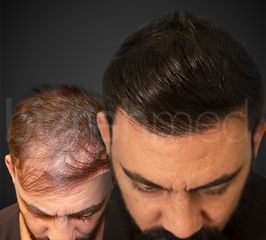 زراعة الشعر - مركز بزرة ميد الطبي