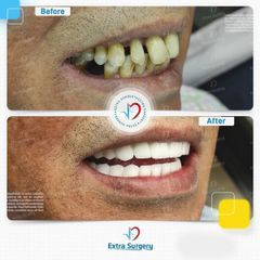 عملية تجميل الأسنان - اكسترا سيرجري