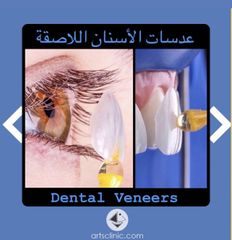 فينير الأسنان - مصحة ارتز