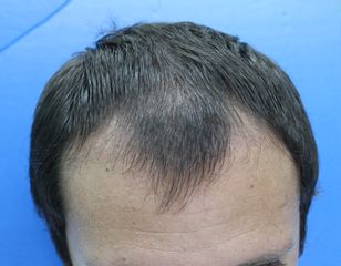 Stem Cell And FUE