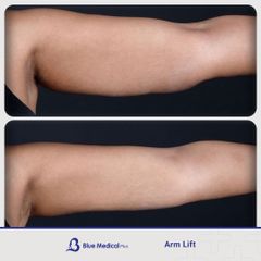 Arm Lift_-04