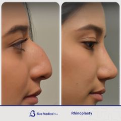 Rhinoplasty-08