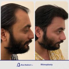 Rhinoplasty-09