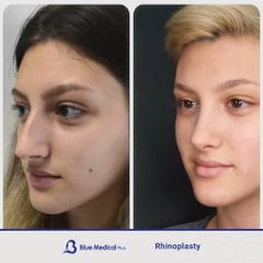 Rhinoplasty-10