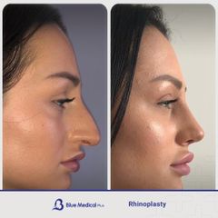 Rhinoplasty