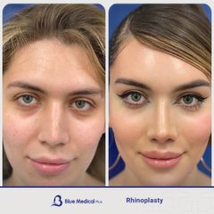 Rhinoplasty-01