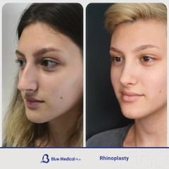 Rhinoplasty-02