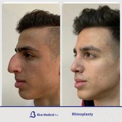 Rhinoplasty-03