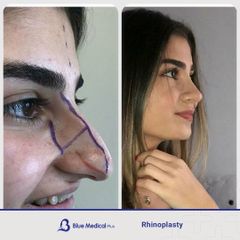 Rhinoplasty-04