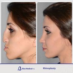 Rhinoplasty-05