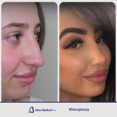 Rhinoplasty-06