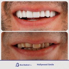 Hollywood Smile-6