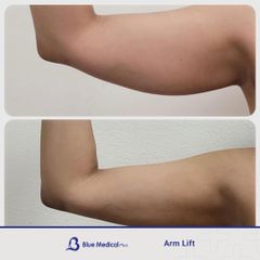 Arm Lift_-07