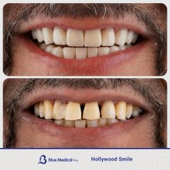 Hollywood Smile