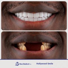 Hollywood Smile-2