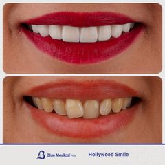 Hollywood Smile-3