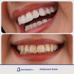 Hollywood Smile-4