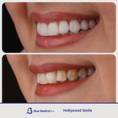 Hollywood Smile-5