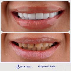 Hollywood Smile-1