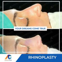 Rhinoplasty-Amazon-Clinic