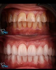 تبييض الأسنان قبل وبعد (4)