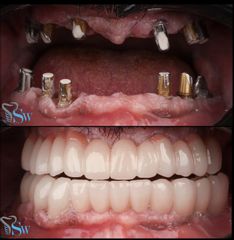 زراعة الأسنان قبل وبعد (3)