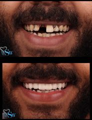 زراعة و تجميل الأسنان قبل وبعد (5)