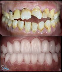 تقويم الأسنان قبل وبعد (4)