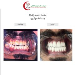 ابتسامة هوليود المتحركة - مركز الدكتور وليد ابو حلاوة الطبي
