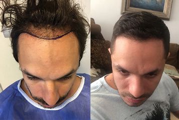 Hair-Transplant- before after