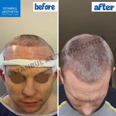Hair-Transplant- before after 2