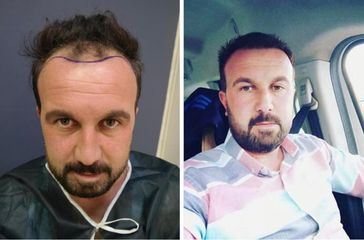 Hair-Transplant- before after 3