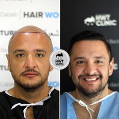 زراعة الشعر قبل وبعد