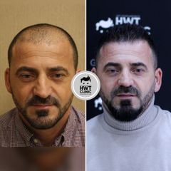 زراعة الشعر قبل وبعد