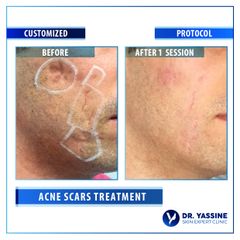 Acne Scars Treatment-01