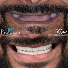 عملية زراعة الأسنان - عيادات البروفيسور