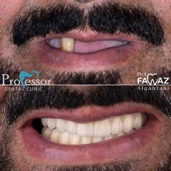 عملية زراعة الأسنان - عيادات البروفيسور