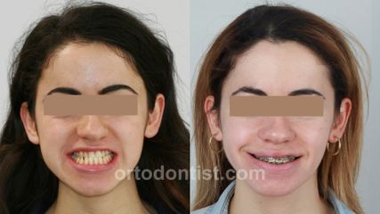 class 3 young patient orthognathic surgery 2